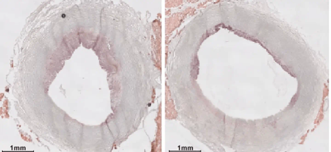 Side by side images of arteries