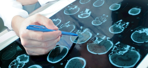 Brain scans of a brain with a neurodegenerative disorder